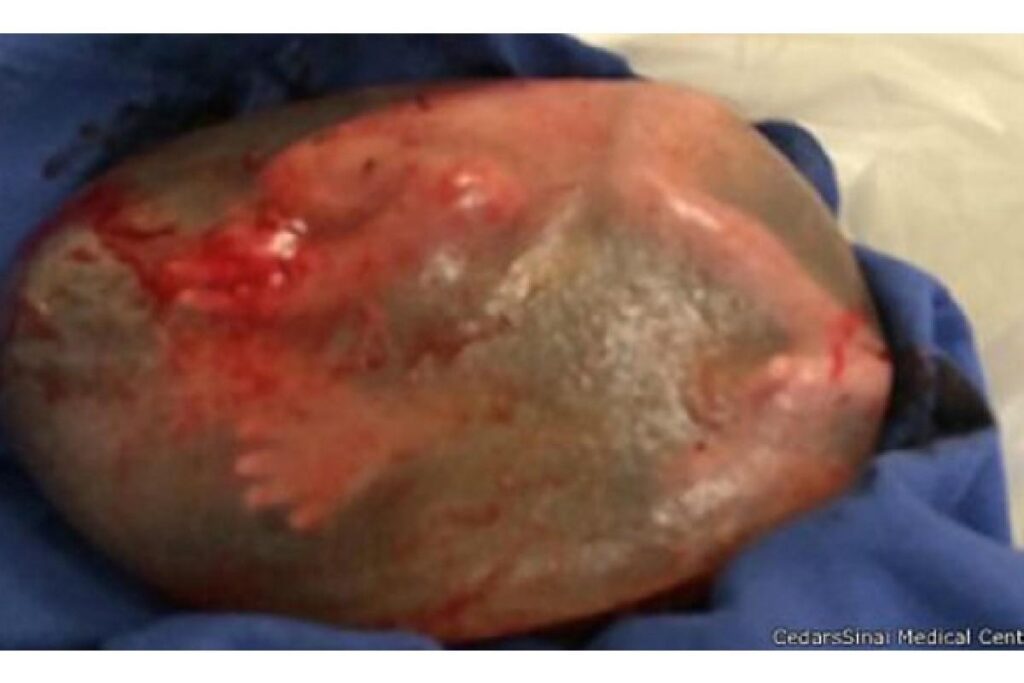 A foto capturou o momento em que o bebê nasceu dentro da bolsa amniótica