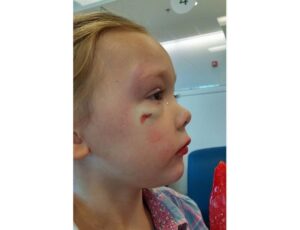 Filha de Merritt com o rosto machucado