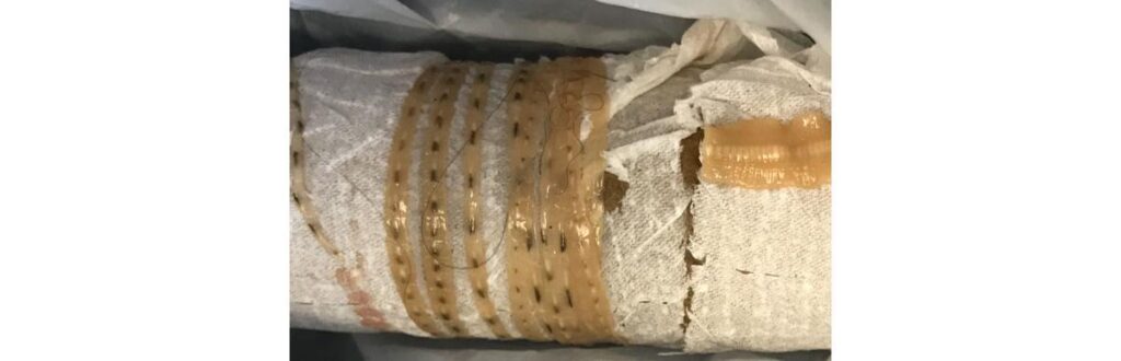 Chocante: homem que só comia sushi desenvolve solitária de mais de 1 metro