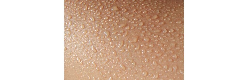 A hiperhidrose atinge aproximadamente 5% das crianças