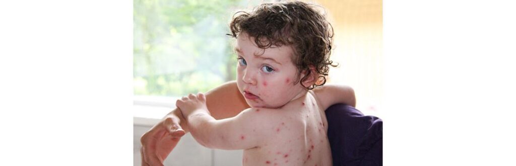 Vacinação é a única proteção do seu filho contra algumas doenças