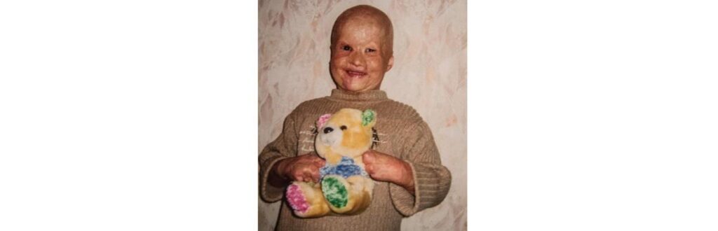 Lyosha, o menino que foi jogado no fogo