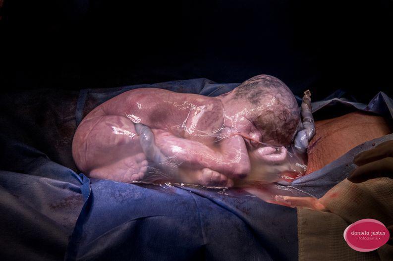 Daniela foi premiada na categoria “Parto” com essa foto de um bebê empelicado