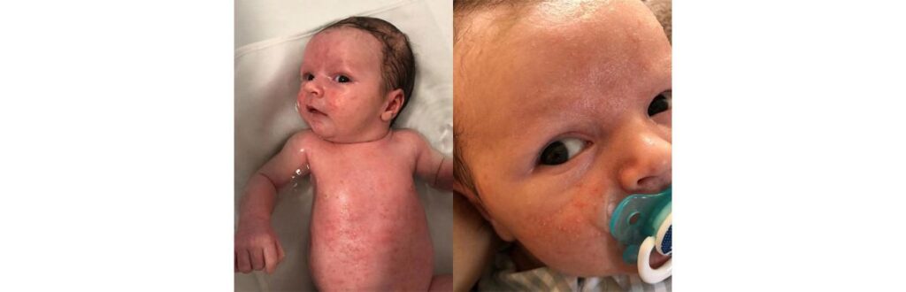 Essa condição pode atingir até 30% dos bebês