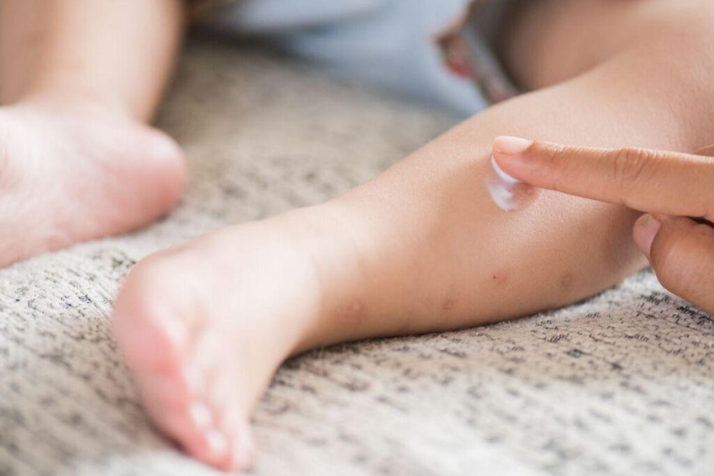 Os casos de sarampo aumentaram muito desde 2013