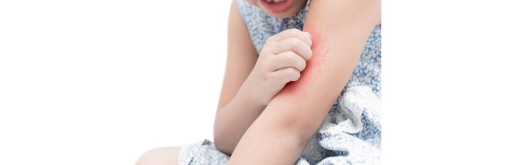 Vamos tirar todas as suas dúvidas sobre picadas de inseto!