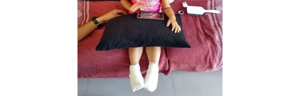 A menina de dois anos teve queimaduras de segundo grau nos pés