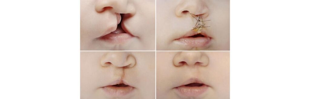 Sem a cirurgia de tratamento, a criança pode ter dificuldades desde a deglutição até a fala