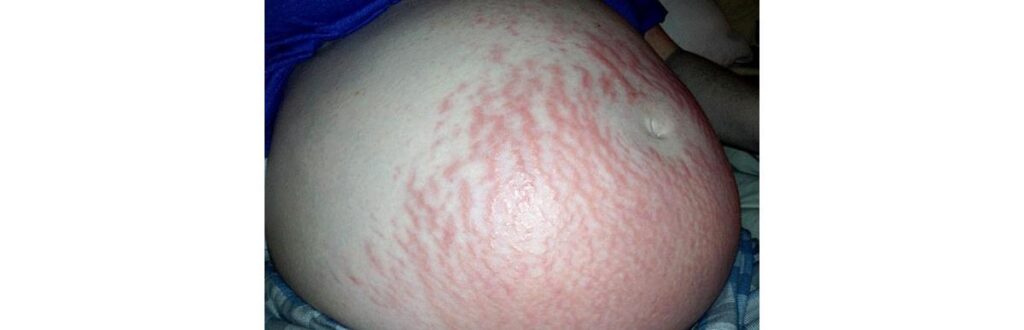 Mãe foi diagnosticada com erupção polimórfica da gravidez