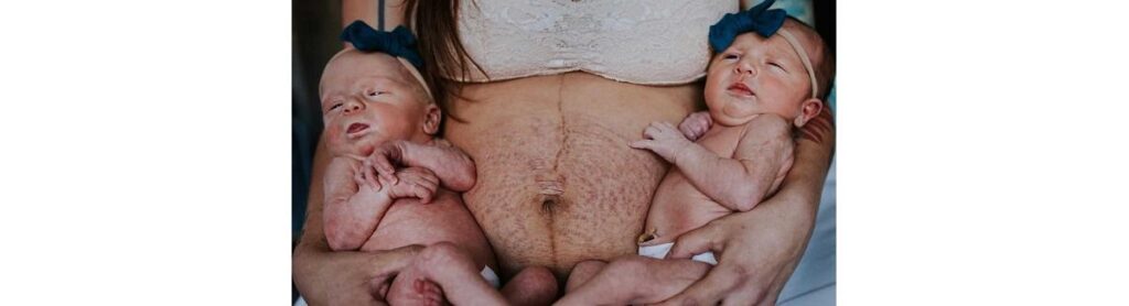 Hayley inspira  mulheres com suas fotos mostrando suas marcas da gestação gemelar