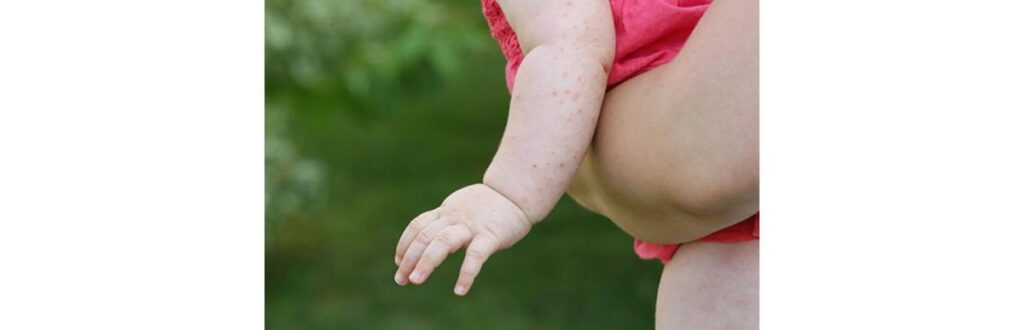 Sarampo mata mais de 135.000 pessoas por ano