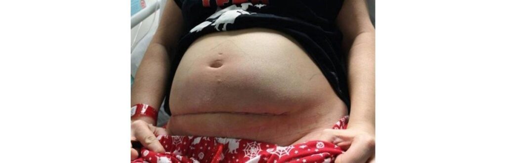 Cicatriz de Bethan após a cirurgia