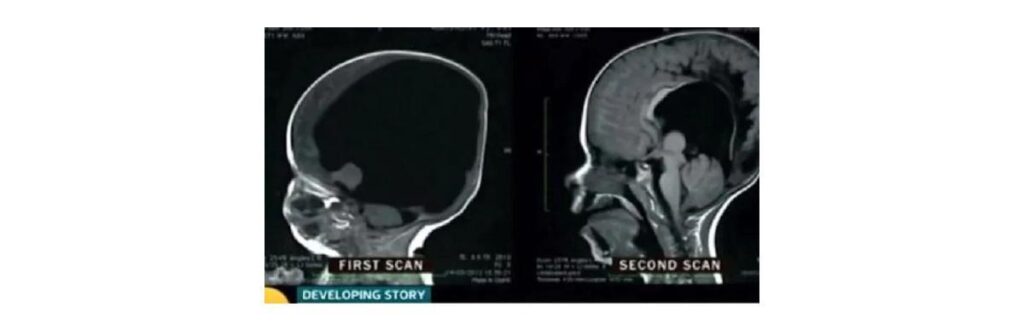 Menino que nasceu sem cérebro faz 6 anos
