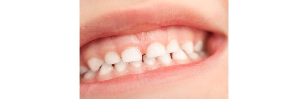 Bruxismo é problema comum durante a infância