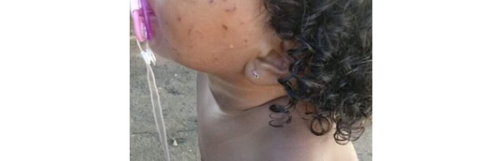A menina estava com marcas de arranhões e mordidas