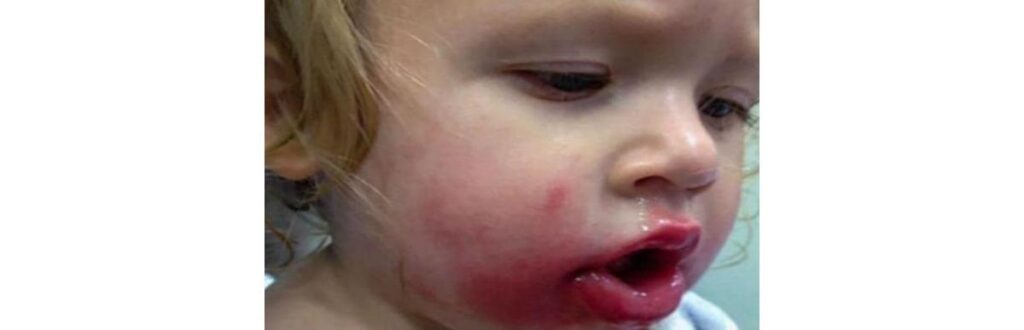 Criança engoliu Mariposa branca venenosa