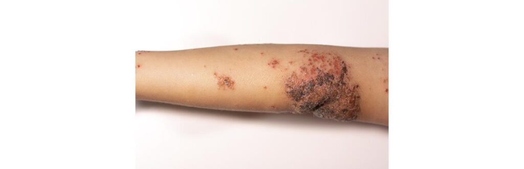 Impetigo é uma doença contagiosa que pode se manifestar em qualquer parte do corpo