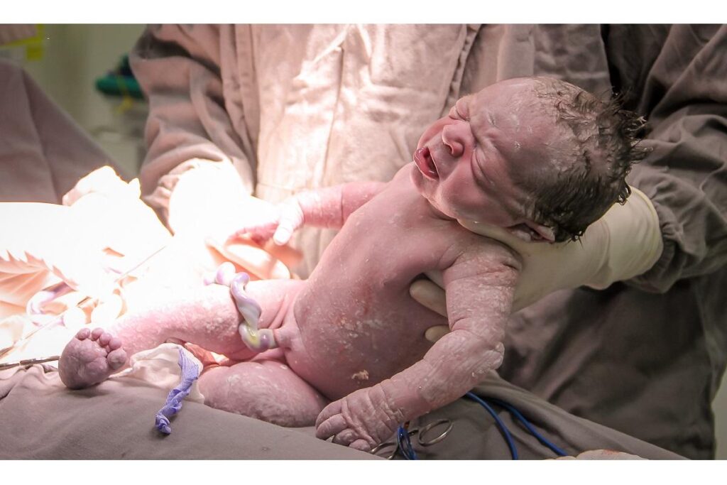 Tadeu nasceu com cordão enrolado em nó verdadeiro