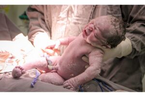 Tadeu nasceu com cordão enrolado em nó verdadeiro