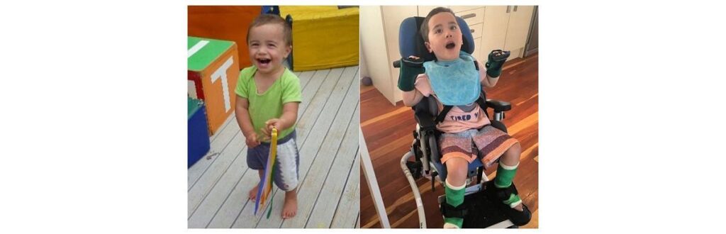 Menino engasga com maçã e fica paraplégico