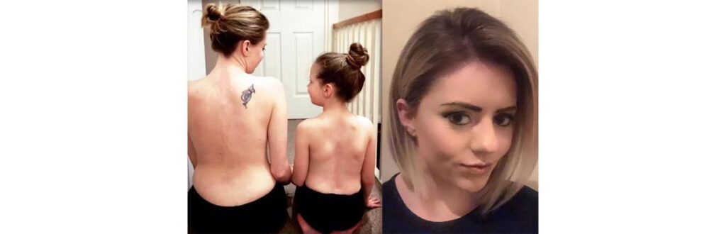 As duas operaram escolioses (