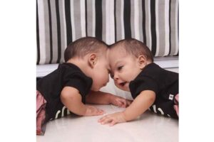 Lis e Mel se viram pela primeira vez, quase um mês depois da cirurgia