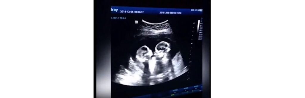 As meninas são prematuras