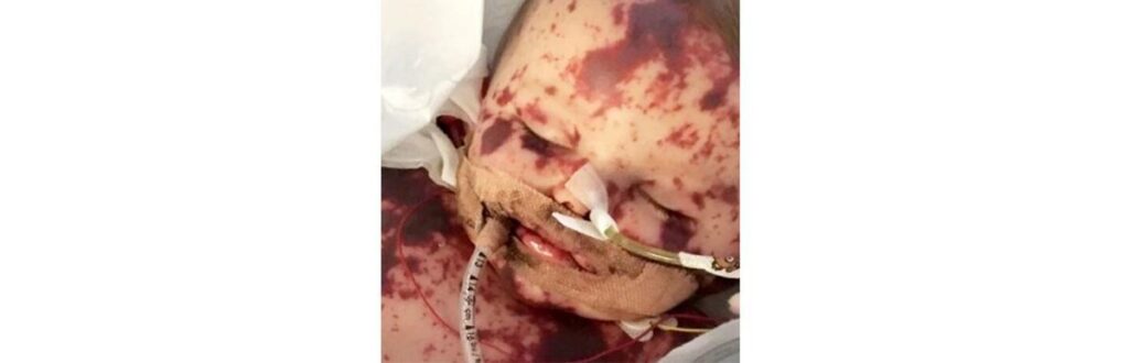 Na foto, Kia e o irmão antes dela contrair a doença