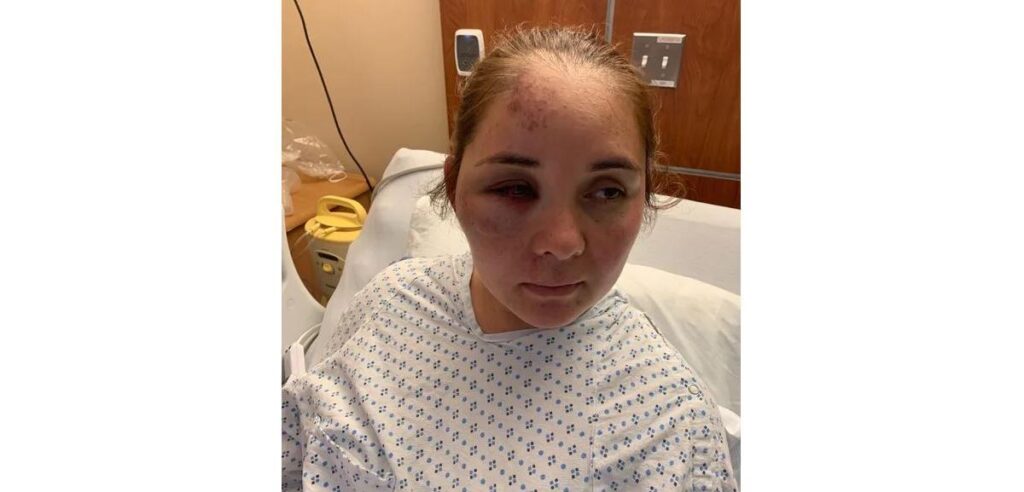 Mãe é agredida e tem fratura faciais