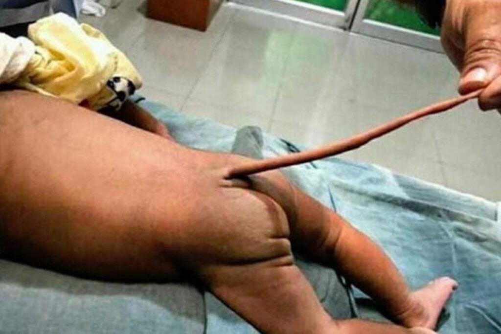 O membro foi removido por uma cirurgia simples