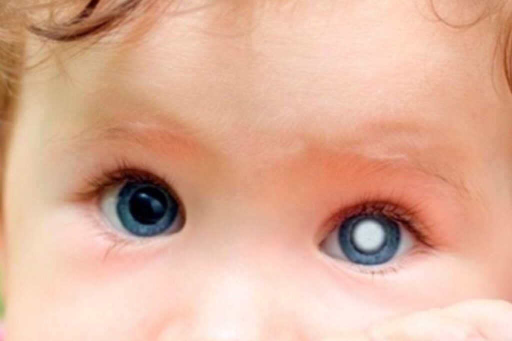 Crianças que apresentam a condição podem ter sensibilidade à luz e visão dupla