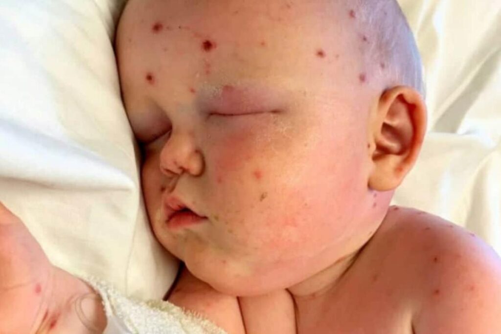 O menino antes de adquirir a catapora