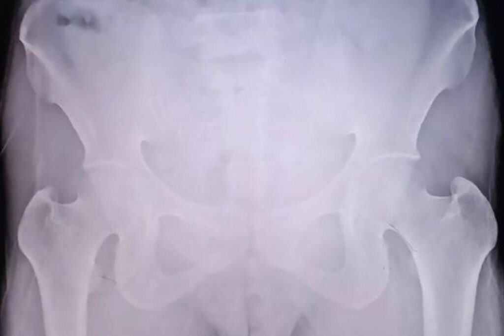 Ela achou que a mola funcionaria como DIU