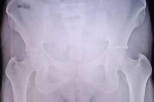 Ela achou que a mola funcionaria como DIU