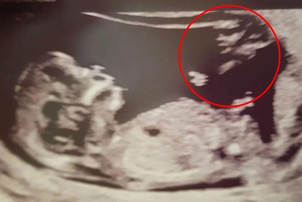 Ela se surpreendeu no ultrassom de 12 semanas