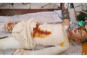 Menino de 8 anos tem o corpo queimado por crianças que praticavam bullying