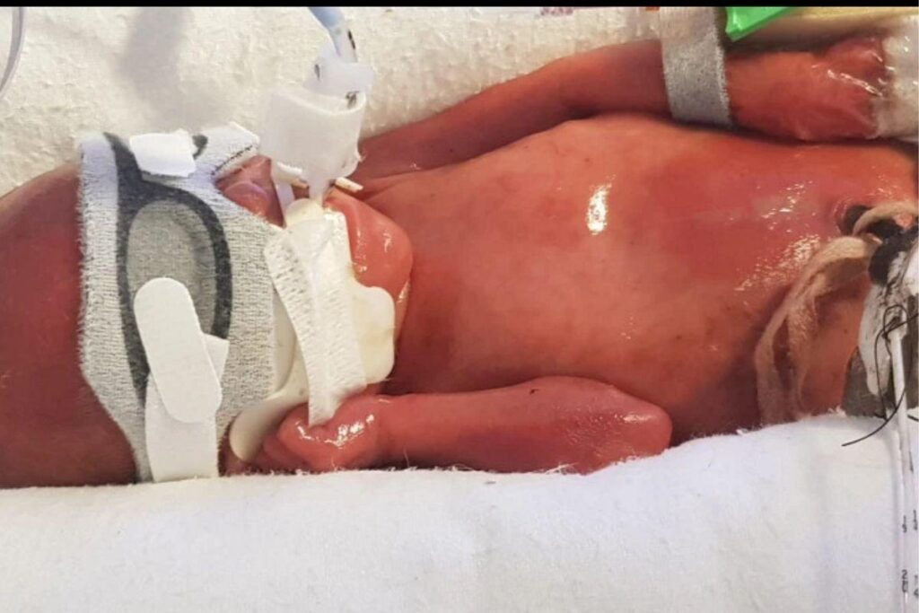 Haris sobreviveu depois que os médicos tentaram a última solução que restou