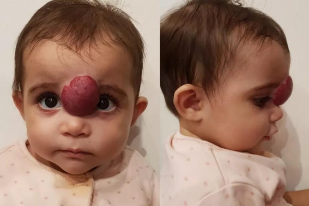 A bebê teve quase 80% da anomalia retirada