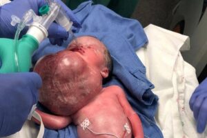 Bella Rose nasceu com um cisto gigante na face