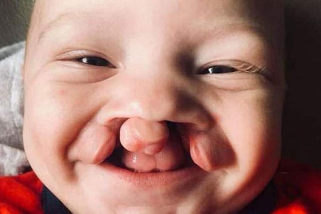Mãe mostra resultado da cirurgia de lábio leporino do filho de 1 ano e 4 meses
