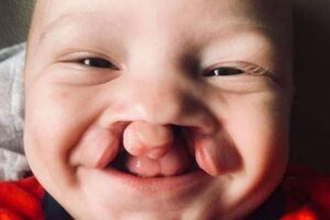 Mãe mostra resultado da cirurgia de lábio leporino do filho de 1 ano e 4 meses