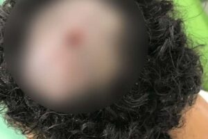 A larva é identificada como “berne”