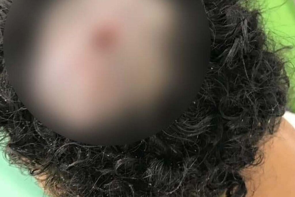 A larva é identificada como “berne”