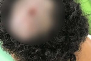 A larva é identificada como “berne”