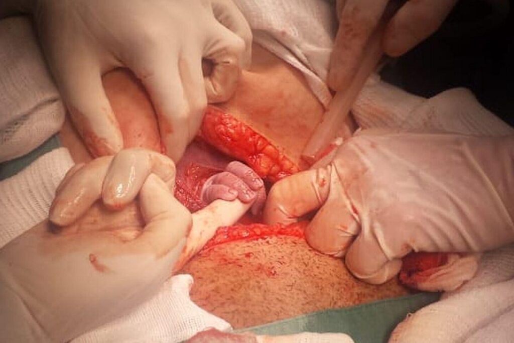 Letícia nasceu de uma cesárea