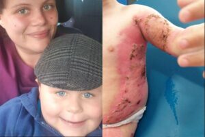 O corpo de Arthur ficou todo queimado