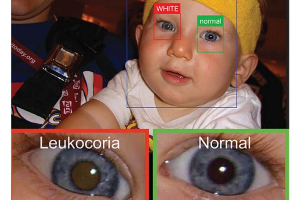 Eles estudaram mais de 50 mil fotos de 40 crianças para criar o banco de dados capazes de identificar as doenças oculares
