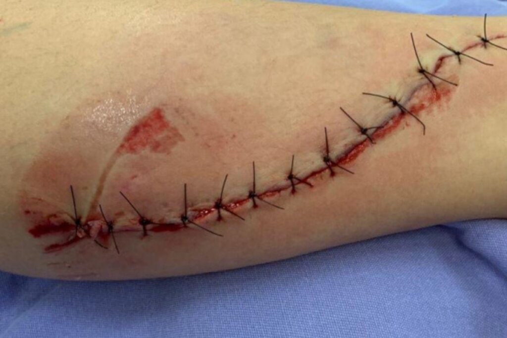 A escada não tinha a borracha de proteção