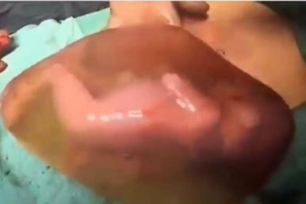 A bolsa amniótica se manteve intacta