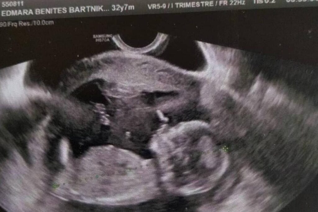 “Tenho um bebê de 11 meses. Fiz laqueadura’”, desabafa Edmara